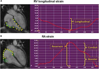 The Prognostic Value of Right Atrial and Right Ventricular Functional Parameters in Systemic Sclerosis